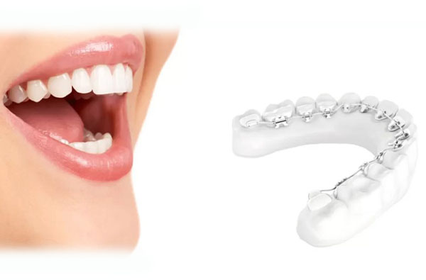 Aparat Dentar Invizibil Win