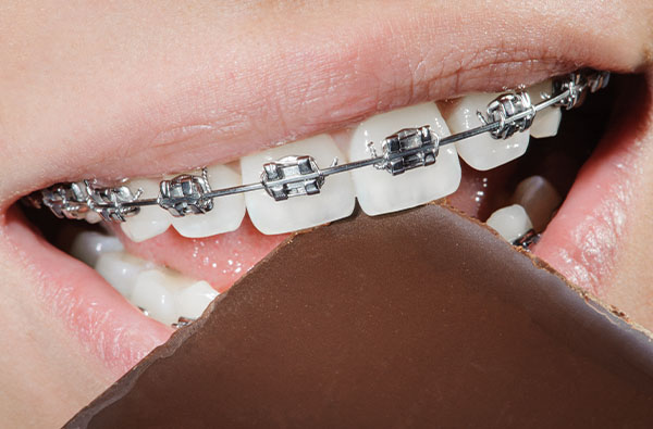 Aparat Dentar Metalic iasi doro dent 1