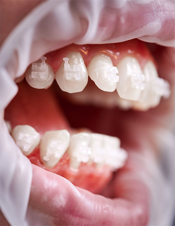 Aparat Dentar Safir iasi doro dent