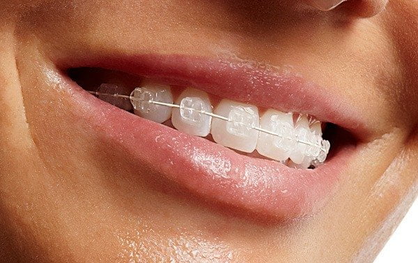 Aparat Dentar Safir