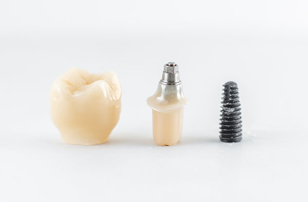Implant Dentar
