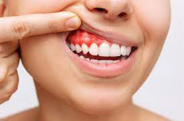 Tratamente Parodontoza iasi doro dent