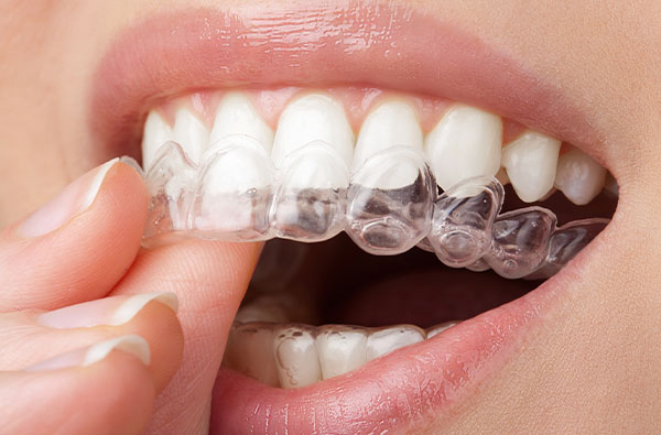 albire dentara iasi doro dent. 1jpg