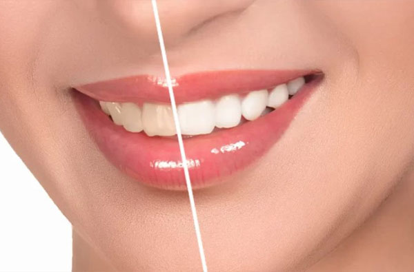 Albire dentara profesionala