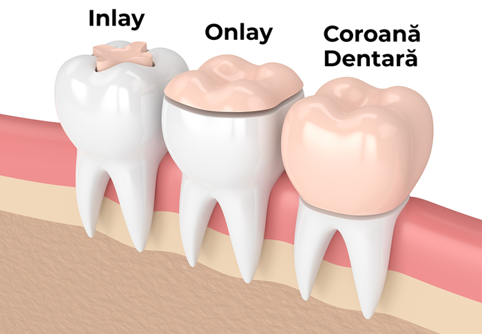 Incrustatii Dentare Iasi